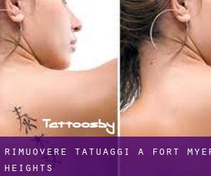 Rimuovere Tatuaggi a Fort Myer Heights
