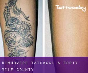Rimuovere Tatuaggi a Forty Mile County