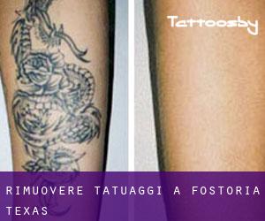 Rimuovere Tatuaggi a Fostoria (Texas)
