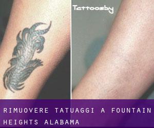 Rimuovere Tatuaggi a Fountain Heights (Alabama)