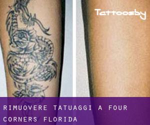 Rimuovere Tatuaggi a Four Corners (Florida)