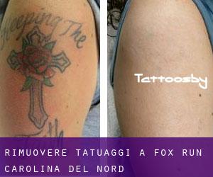 Rimuovere Tatuaggi a Fox Run (Carolina del Nord)