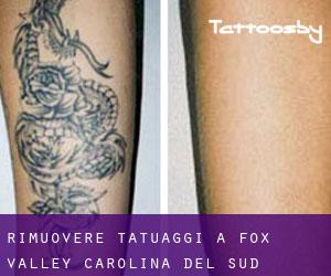 Rimuovere Tatuaggi a Fox Valley (Carolina del Sud)
