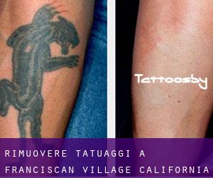 Rimuovere Tatuaggi a Franciscan Village (California)