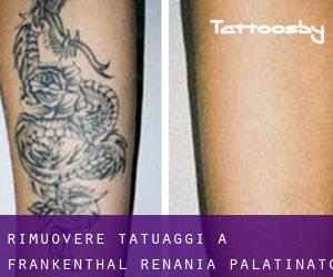 Rimuovere Tatuaggi a Frankenthal (Renania-Palatinato)