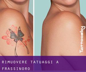 Rimuovere Tatuaggi a Frassinoro