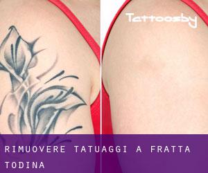 Rimuovere Tatuaggi a Fratta Todina
