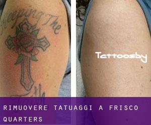 Rimuovere Tatuaggi a Frisco Quarters
