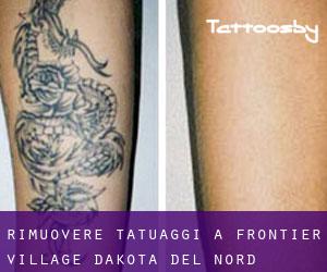 Rimuovere Tatuaggi a Frontier Village (Dakota del Nord)