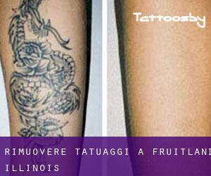 Rimuovere Tatuaggi a Fruitland (Illinois)