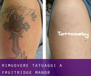 Rimuovere Tatuaggi a Fruitridge Manor