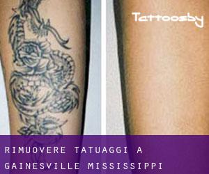 Rimuovere Tatuaggi a Gainesville (Mississippi)