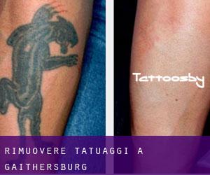 Rimuovere Tatuaggi a Gaithersburg