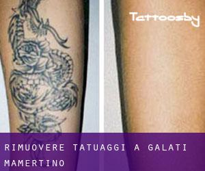 Rimuovere Tatuaggi a Galati Mamertino