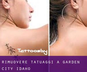 Rimuovere Tatuaggi a Garden City (Idaho)