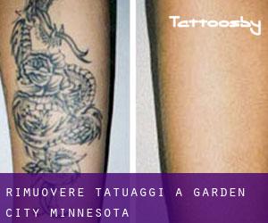 Rimuovere Tatuaggi a Garden City (Minnesota)