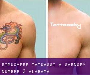 Rimuovere Tatuaggi a Garnsey Number 2 (Alabama)