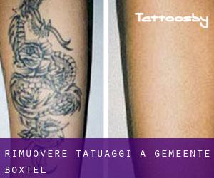 Rimuovere Tatuaggi a Gemeente Boxtel