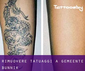 Rimuovere Tatuaggi a Gemeente Bunnik