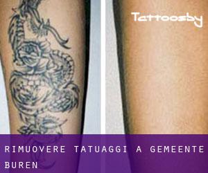 Rimuovere Tatuaggi a Gemeente Buren