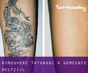 Rimuovere Tatuaggi a Gemeente Delfzijl