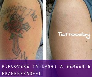 Rimuovere Tatuaggi a Gemeente Franekeradeel