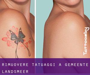 Rimuovere Tatuaggi a Gemeente Landsmeer