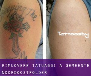 Rimuovere Tatuaggi a Gemeente Noordoostpolder