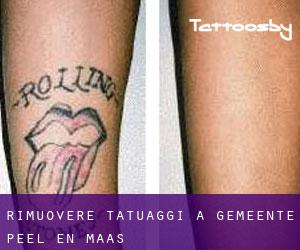 Rimuovere Tatuaggi a Gemeente Peel en Maas