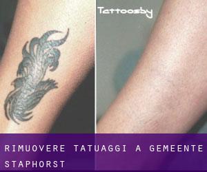 Rimuovere Tatuaggi a Gemeente Staphorst