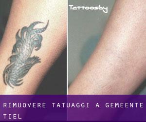 Rimuovere Tatuaggi a Gemeente Tiel