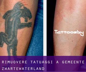 Rimuovere Tatuaggi a Gemeente Zwartewaterland
