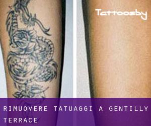 Rimuovere Tatuaggi a Gentilly Terrace