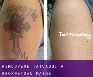 Rimuovere Tatuaggi a Georgetown (Maine)