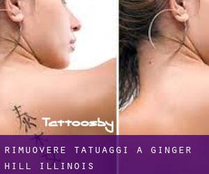 Rimuovere Tatuaggi a Ginger Hill (Illinois)
