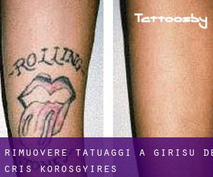 Rimuovere Tatuaggi a Girişu de Criş / Kőrösgyíres