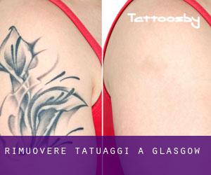Rimuovere Tatuaggi a Glasgow
