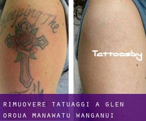 Rimuovere Tatuaggi a Glen Oroua (Manawatu-Wanganui)