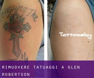 Rimuovere Tatuaggi a Glen Robertson