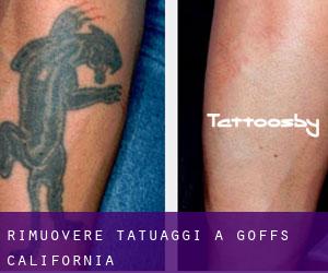 Rimuovere Tatuaggi a Goffs (California)