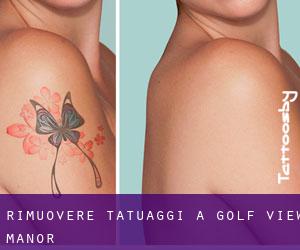 Rimuovere Tatuaggi a Golf View Manor