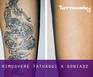 Rimuovere Tatuaggi a Goniadz