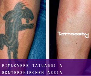 Rimuovere Tatuaggi a Gonterskirchen (Assia)
