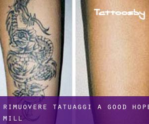 Rimuovere Tatuaggi a Good Hope Mill
