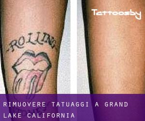 Rimuovere Tatuaggi a Grand Lake (California)