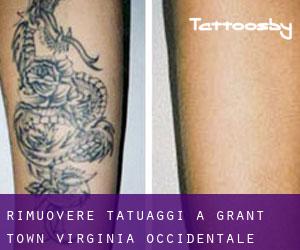 Rimuovere Tatuaggi a Grant Town (Virginia Occidentale)