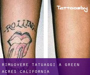 Rimuovere Tatuaggi a Green Acres (California)