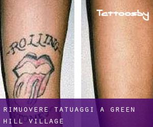 Rimuovere Tatuaggi a Green Hill Village
