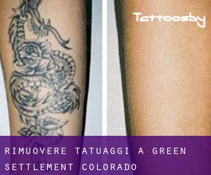 Rimuovere Tatuaggi a Green Settlement (Colorado)