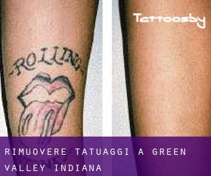 Rimuovere Tatuaggi a Green Valley (Indiana)